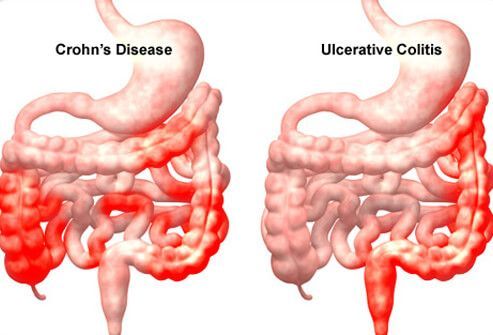 Tor Vergata – Marino Proud of the research on Crohn’s disease