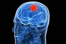 Tumors what are the most common false beliefs